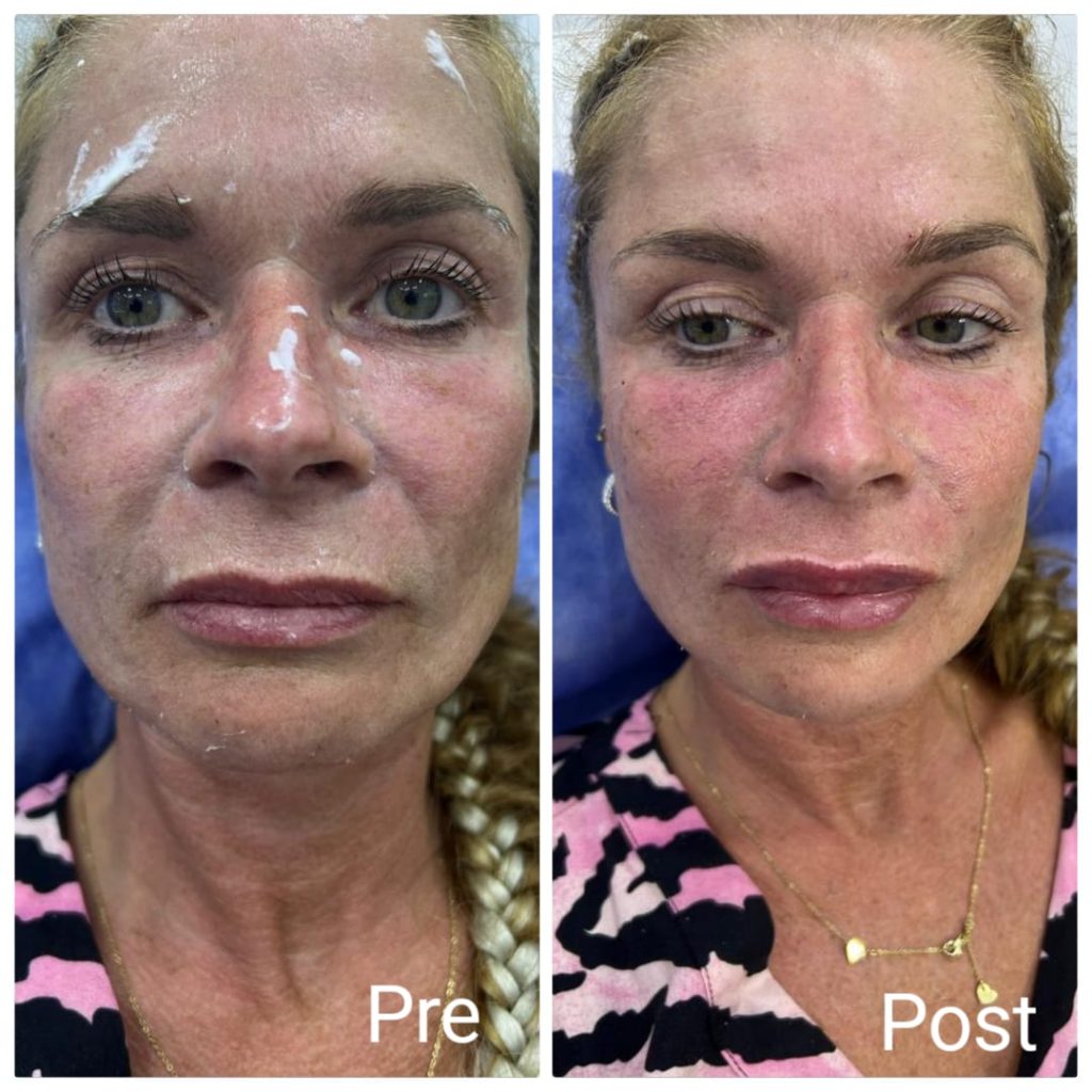 Hyaluronic injections for the face